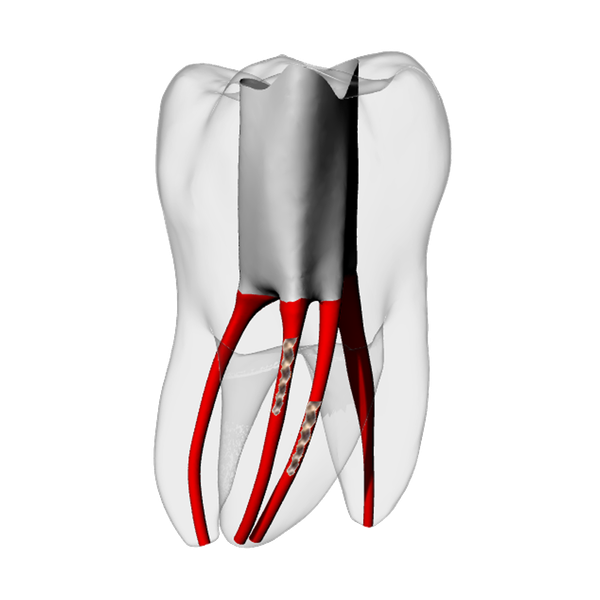 Molar – Two Broken files | Dental Training Models | DRSK