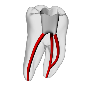 Molar – Accessed, Merging canals, Clear | Dental Training Models | DRSK