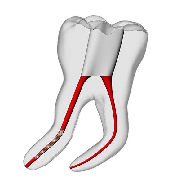 Molar – 6mm Broken File, 30° Distal Canal | Dental Training Models | DRSK
