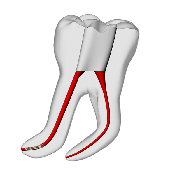 Molar – 3mm Broken File, 60° Distal Canal | Dental Training Models | DRSK