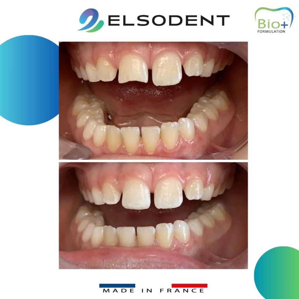 PURESHADE – ELSODENT SAS, Dental Composites
