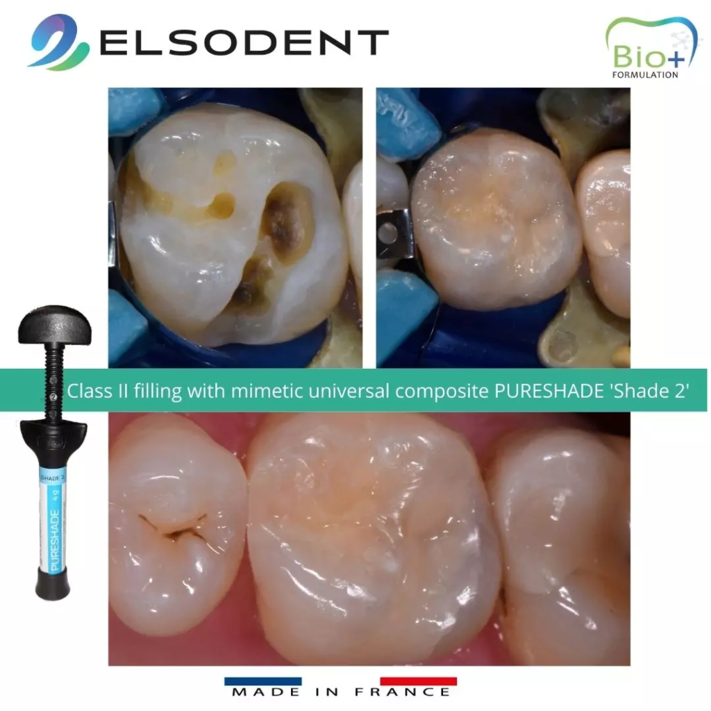 PURESHADE – ELSODENT SAS, Dental Composites