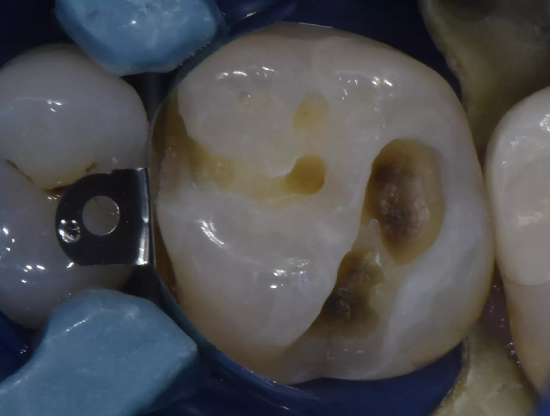 PURESHADE shade 2 – ELSODENT SAS, Dental Composites
