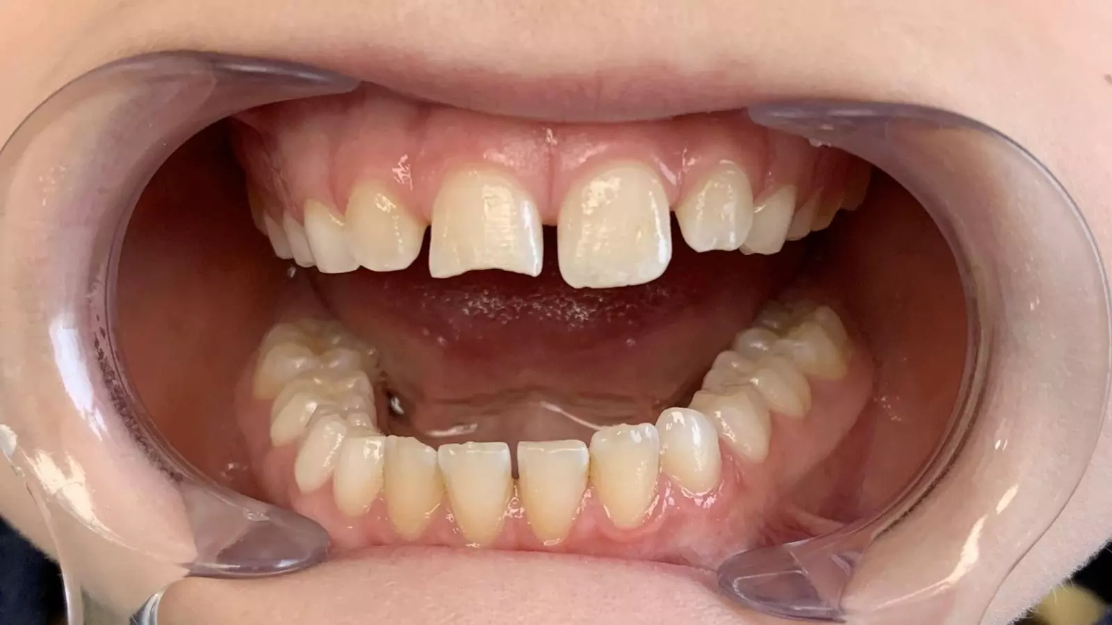 PURESHADE Shade 1 – ELSODENT SAS, Dental Composites