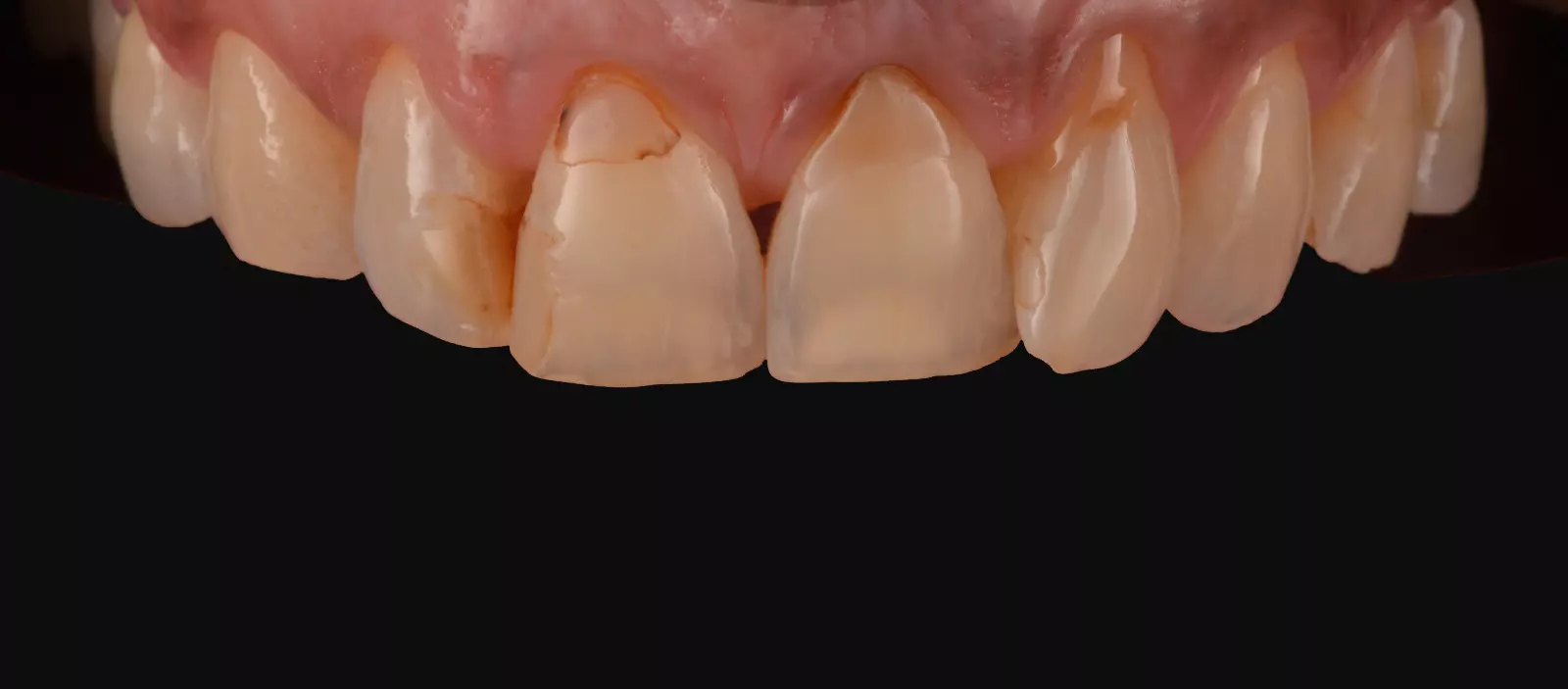 PURESHADE Shade 2 – ELSODENT SAS, Dental Composites
