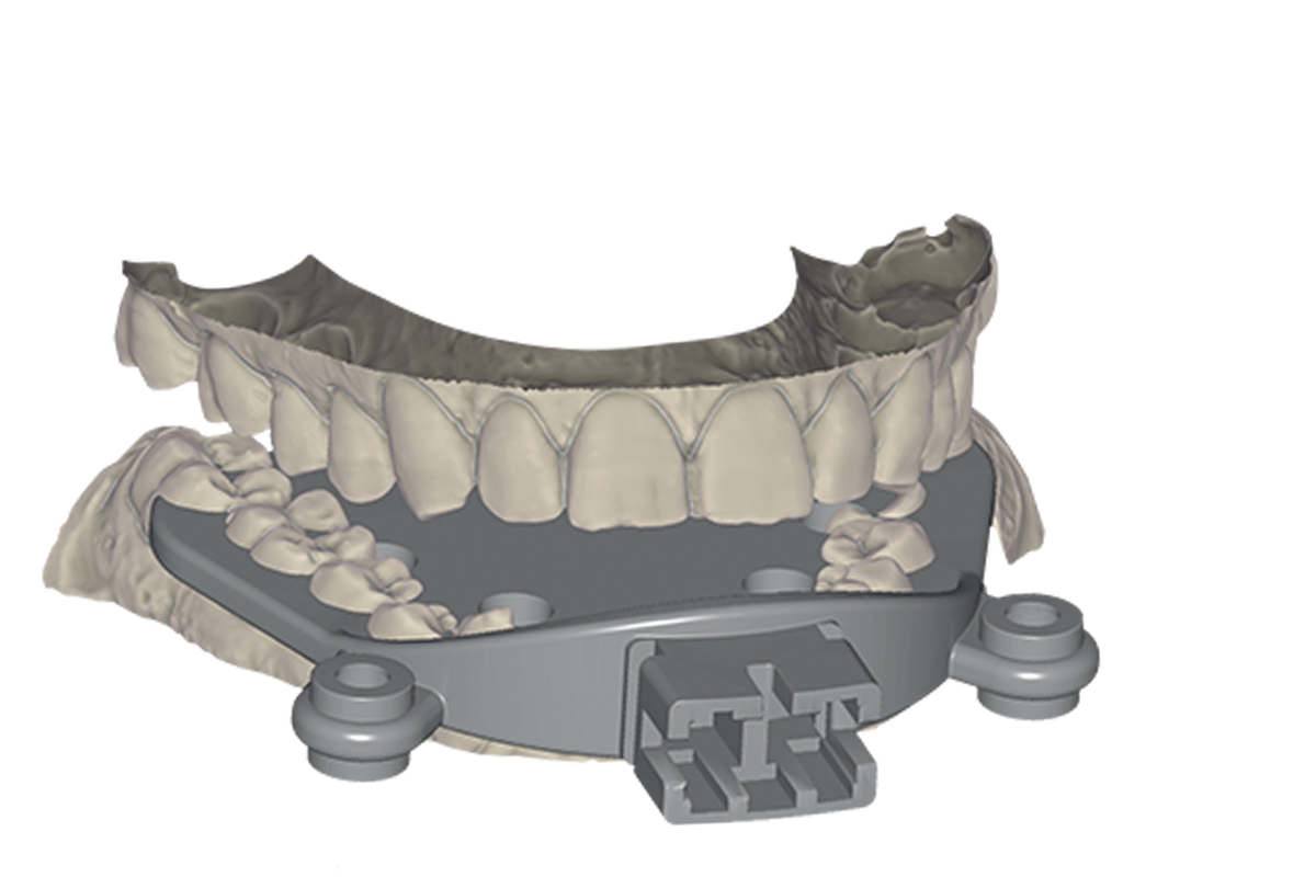 Jaw Motion Import Module – Exocad, CAD/CAM Software