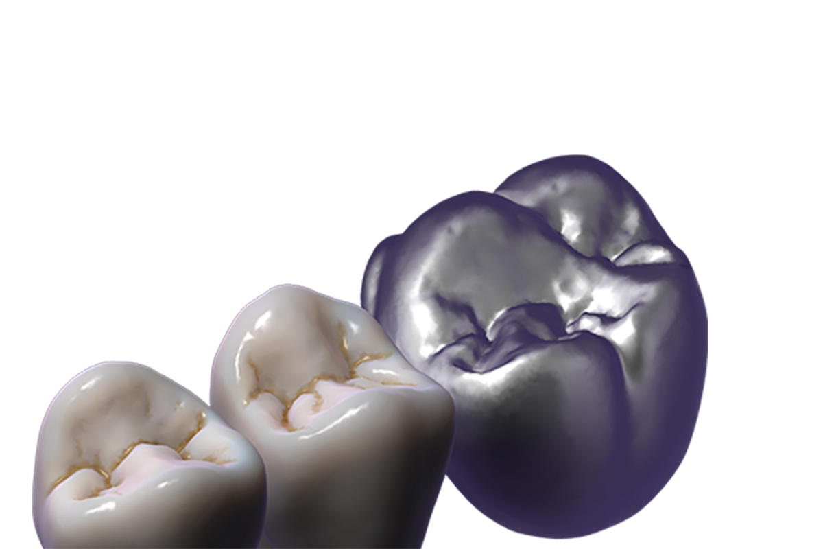 TruSmile™ Module – Exocad, CAD/CAM Software