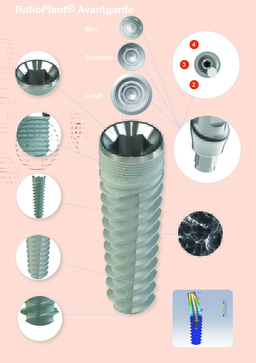 RatioPlant® Avantgarde – HumanTech Dental GmbH, Implant Systems