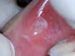 mirafluor-gel strawberry – Hager Werken, Fluoridierung