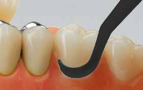 Miraclean-Implant Schwarz Nr. 2 – Hager Werken, Implantatkomponenten & Zubehör