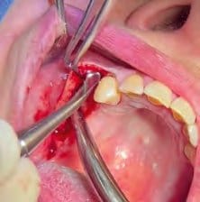 Weichgewebsexpander, gewinkelt, 6,5 mm – Helmut Zepf Medizintechnik, Periodontal Surgery