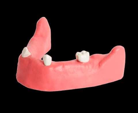 Partially Edentulous Models for Implant Practice – Navadha Enterprises, Equipment