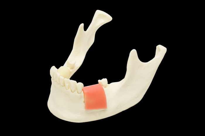Model for Implant Placement with Replaceable Bone Blocks of Different Bone Density – Navadha Enterprises, Equipment