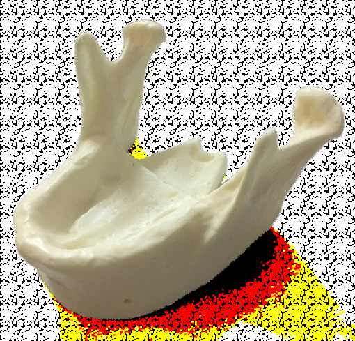 Modèle mandibulaire pour formation en implantologie – Navadha Enterprises, Implant Patient Education Materials