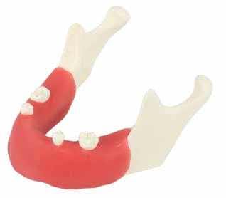 Partially Edentulous Mandible with Ramus