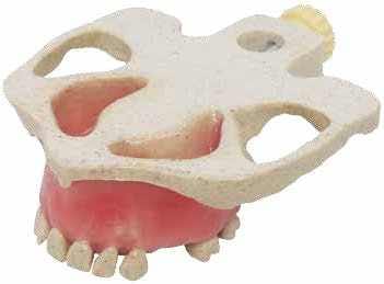 Radiopaque Sinus Elevation & Implant Placement Model