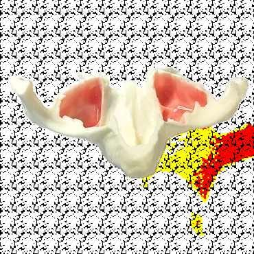 Anatomisches Kiefermodell in Originalgröße mit Sinus für Zygomatikum-Implantate