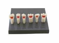 Pulpectomy Teeth for Primary Dentition Model