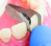 Unica Proximal anterior Matrizen (50 Stück)