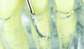 Mini-Curette Gracey GRA 1/2M5 (ERGO)