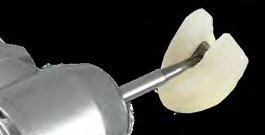 Crown Spreader