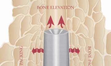 Osteotome SCHWERT FIG. 127