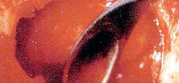 Sinus Lift Curette Standard FIG. 1