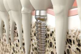 Gingivectomy Knife KIRKLAND