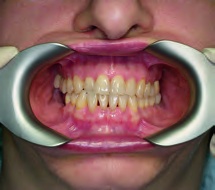 Cheek Retractor for Intraoral Photography, 1/2 Left Sided