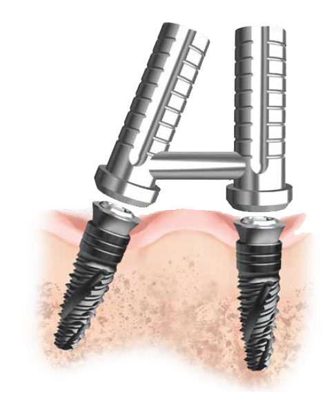 ON-FLAT ABUTMENT SYSTEM