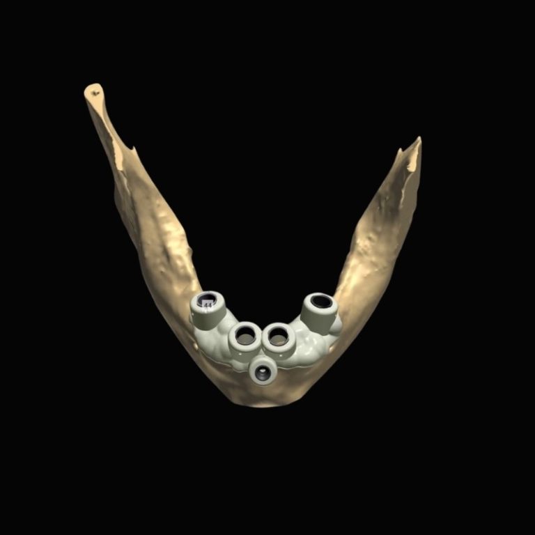 Surgical Guides – Krausz Dental Lab, Implant Surgical Kits