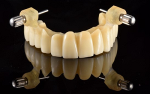 Remount Guide – Krausz Dental Lab, Implant Surgical Kits