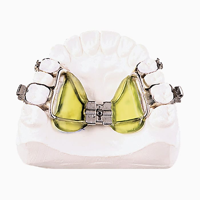Haas Palatal Seperator – lab3d, Intraoral Appliances