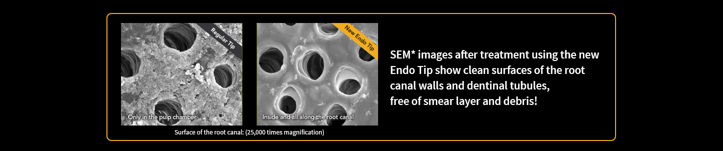 New Endo Tip for LiteTouch™