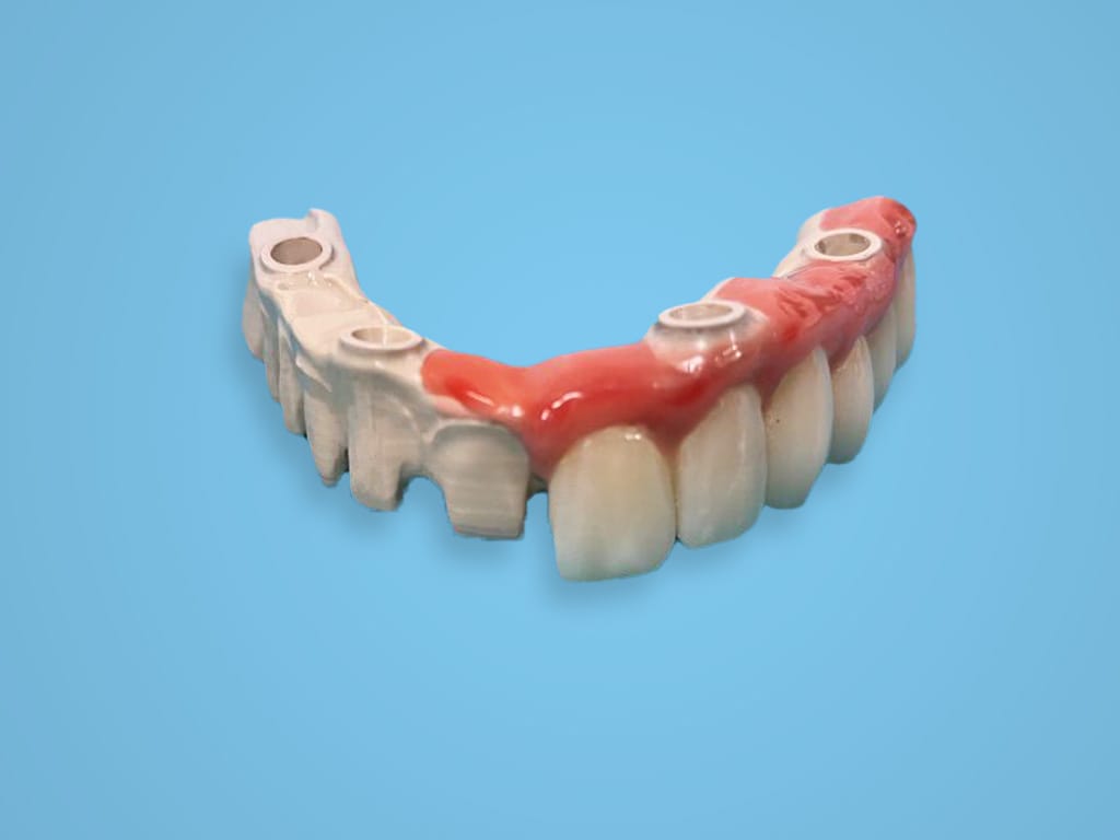 Bridge de Siewert – Medical Precision Implants, S.A., Denture Resins