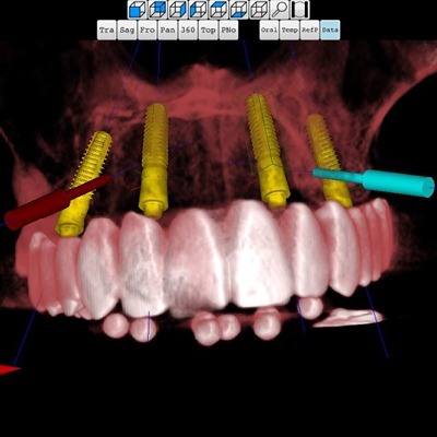 Organical Dental Implant