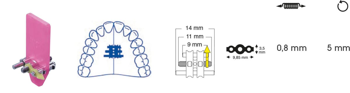 Trapezdehnschraube – Orthobasics GmbH & Co. KG, Intraoral Appliances