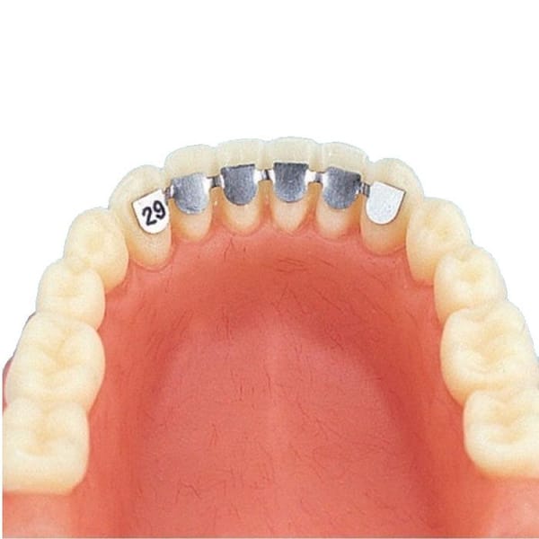 Kleberetainer Eckzahn zu Eckzahn