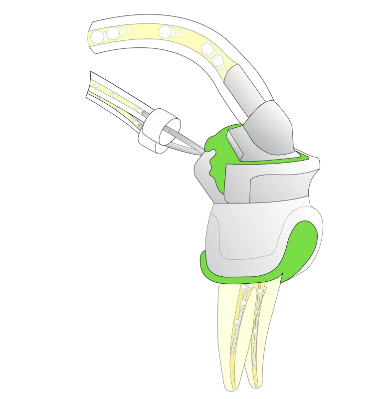 PulpSucker Prämolaren-Kit – PlanB Dental, Spritzen
