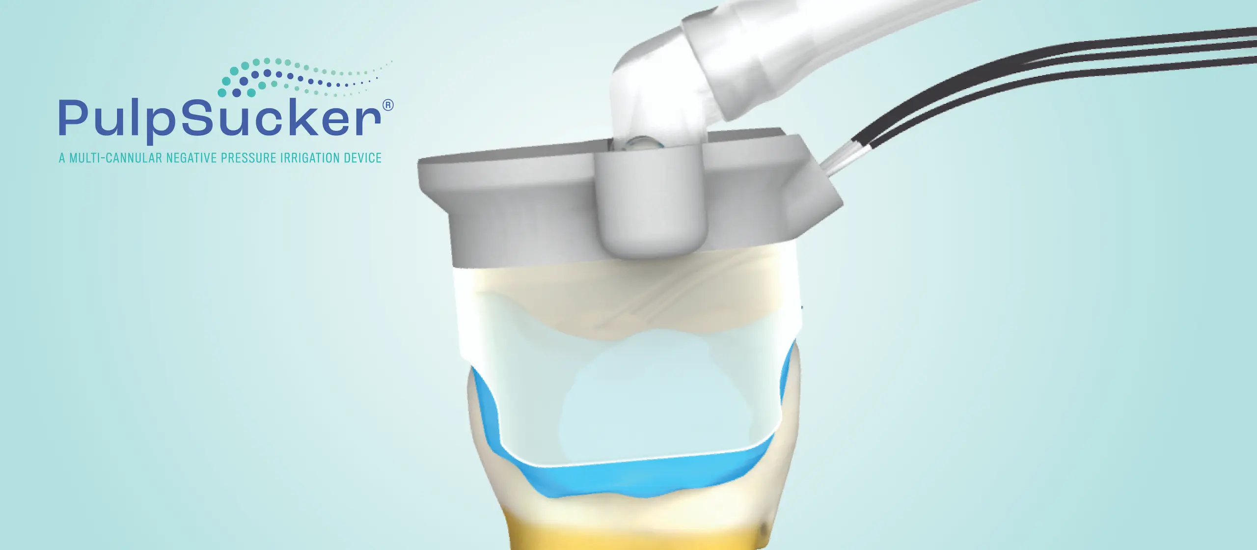 PulpSucker (PS) – PlanB Dental, Endodontic Equipment