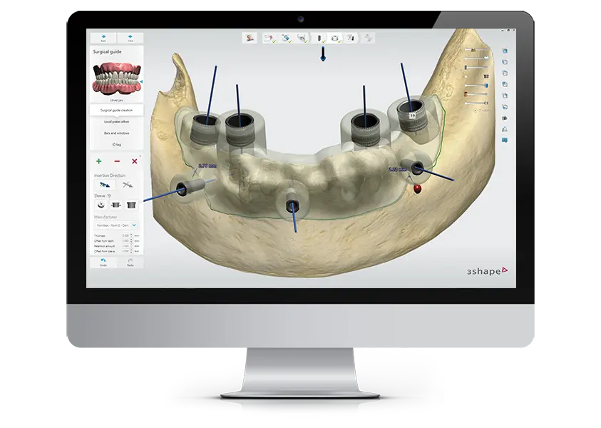 3Shape Implant Studio