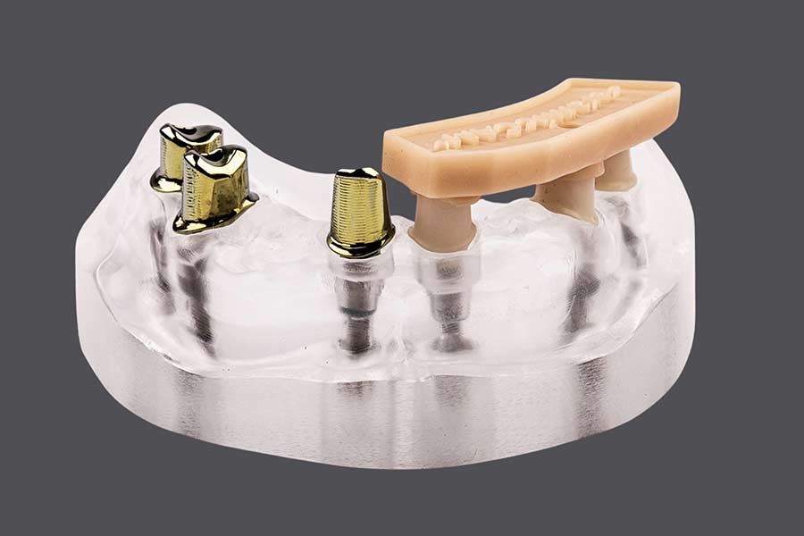 Individuelle Abutments