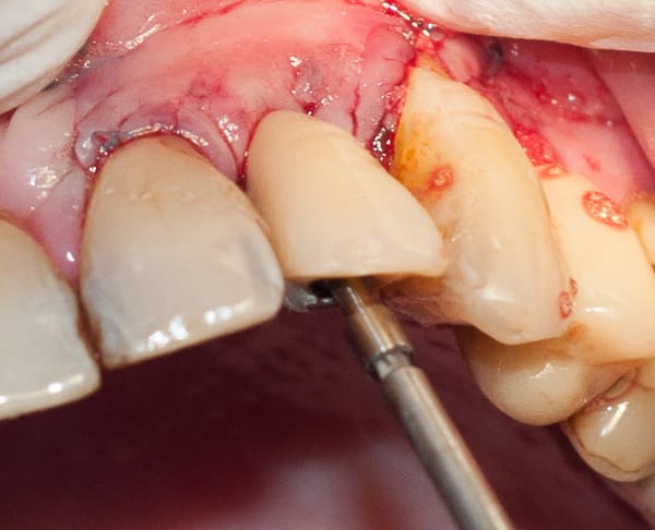 Tree·Oss SIMPLE – Tapered Implant with simplified technique internal hex connection