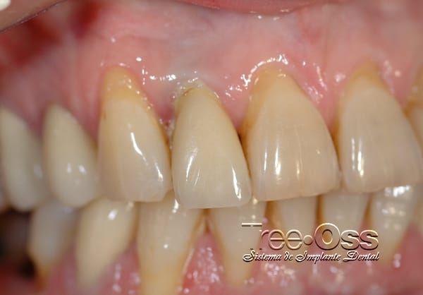 Tree•Oss ANATOMIC – External Connection