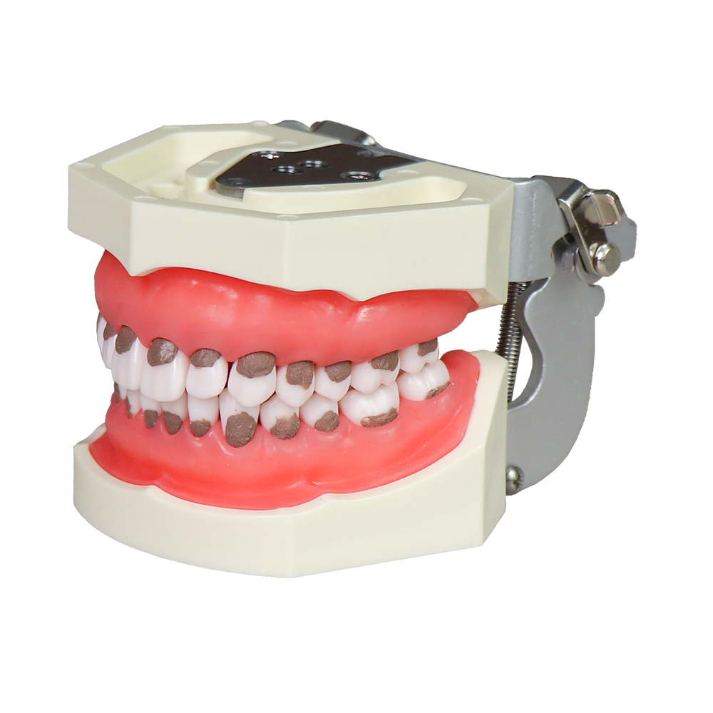 Asian Soft Gum Dental Calculus Model with FE Articulator – Removable Teeth for Scaling Practice JG-Y6-F – FOSHAN JINGLE MEDICAL EQUIPMENT CO.,LTD., Demonstration Models