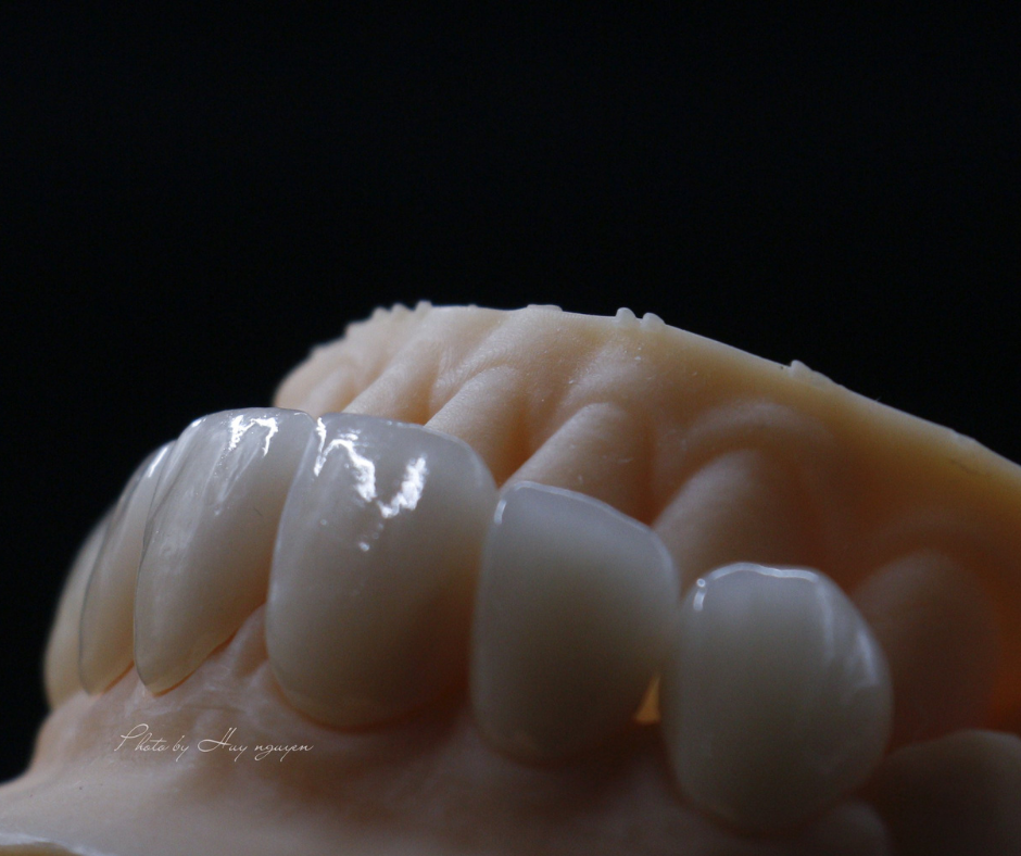 IPS E.max Dental Porcelain – Vu Gia dental lab Co., ltd, Ceramic Materials