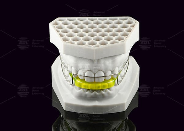 Acrylic Orthodontic Bionator Appliance Corrects Class II Malocclusion