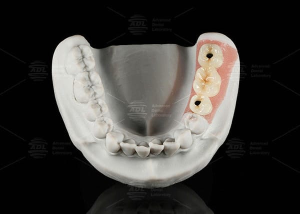 Screw Retained Titanium Custom Abutment Porcelain Fused To Zirconia