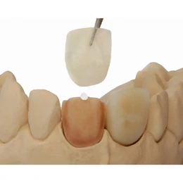 GLUFI - temporary CAD/CAM fixation material