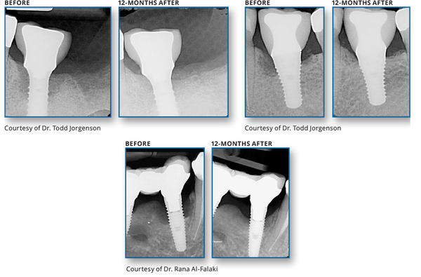 REPAIR IMPLANT™